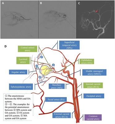 Comparison of Intra-Arterial Chemotherapy Efficacy Delivered Through the <mark class="highlighted">Ophthalmic Artery</mark> or External Carotid Artery in a Cohort of Retinoblastoma Patients